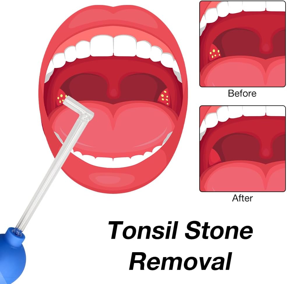 OralHealthHeroes™ Tonsil Stone Cupping Glass