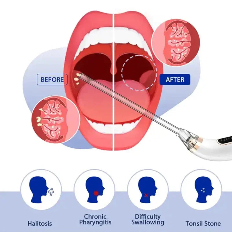 OralHealthHeroes™ Electronic Tonsil Stone Removal Vacuum