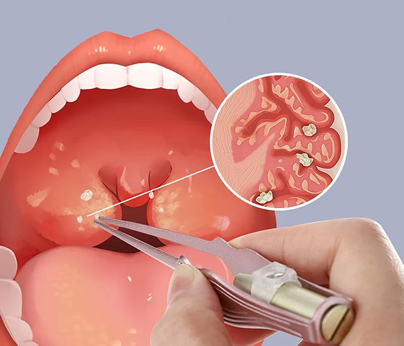 OralHealthHeroes™ Tonsil Stone Removal Tools with LED Light